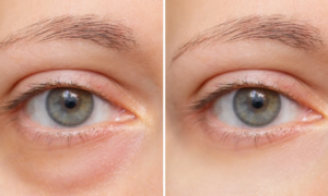 These dark circles that never go away: this protocol validated by dermatologists to finally really reduce them