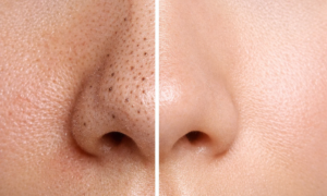 "Blackheads are over!" this facial device will purify your skin like never before