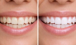 "Perfect smile in 7 days" this $10 teeth whitening kit erases stains like magic