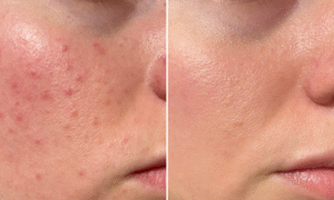 "Bye buttons" : this SPF50 solar fluid, made in France, available in pharmacies, blurs imperfections
