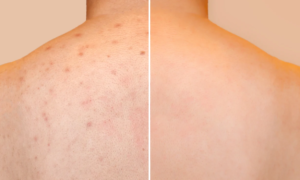 "Goodbye to all the imperfections on the back that are hard to reach" : this Bioderma spray visibly reduces imperfections, redness and marks