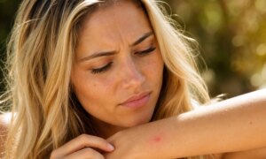 Mosquitoes, bites: here are the best treatments to soothe your skin this summer