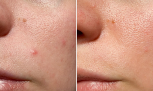 "In 24 hours, my pimple disappeared" : this hyper-concentrated roll-on at $9 helps to cleanse the skin against imperfections
