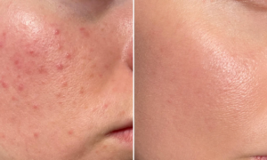 "These gummies healed me from the inside out" : this anti-blemish treatment with zinc is THE solution against hormonal acne