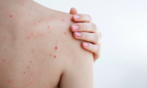 Body acne: this dermatologically tested 360° spray reduces imperfections located on the back, bust and shoulders