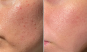 Acne rebound: this low-cost special anti-imperfection serum, with clinically proven effectiveness, reduces imperfections, blackheads and tightens pores