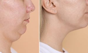 Goodbye to the double chin: this innovative tool targets the fat in the lower face with a formula rich in active ingredients and an integrated roll-on