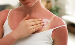 Sunburn: this fresh hydrating gel with lotus flower and white tea relieves sun damage in record time