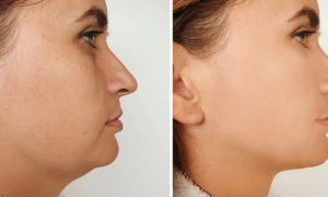 This little tool sold for $7 on Amazon reshapes the oval of the face and makes the double chin disappear (only 5 minutes of use per day is enough to obtain stunning results)