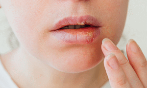 Cold sore: this Compeed treatment to apply at the first tingling