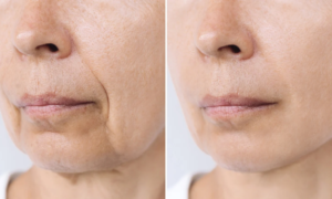 Fine lines around the mouth: this hyaluronic acid treatment rated 100/100 on Yuka promises a plumping effect without injection