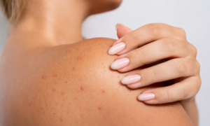 “I have suffered from bacne for years and this product has finally solved my problem”: this body spray eliminates imperfections located on the back, chest and shoulders