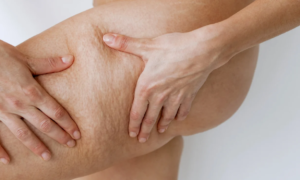 “I made my orange peel disappear in two weeks”: this Aroma-Zone active ingredient at only 10 euros has a proven action on cellulite and promotes restructuring and firming of the skin