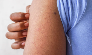 Keratosis pilaris: why does it appear and what does science say to improve its appearance?