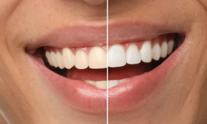 “People ask me where I did my whitening”: this whitening toothpaste sold for $8 eliminates plaque and prevents cavities to preserve oral health