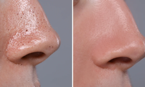 Goodbye blackheads: this anti-blackhead treatment duo deeply unclogs pores without damaging the skin (rated 4.6/5)