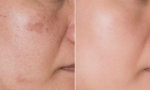 “I didn’t think I would see such a difference”: this La Nouvelle Peau night cream erased all my sun spots accumulated this summer