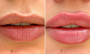 "The result is stunning" : this red light treatment for the mouth replaces plumping glosses for smooth and luscious lips